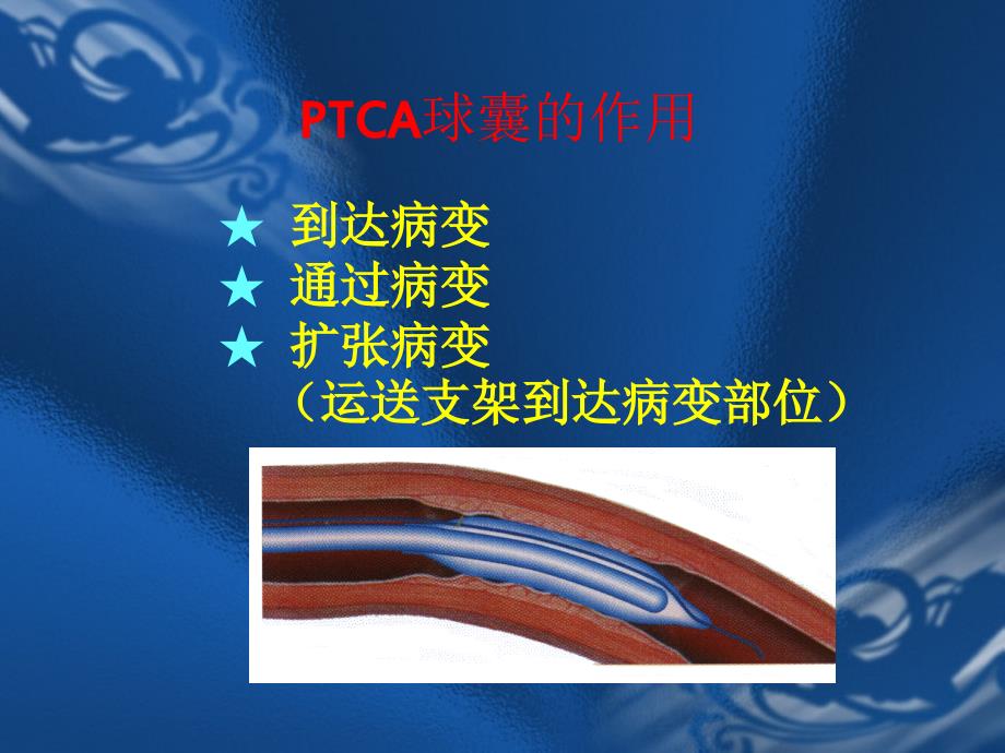 支架的选择原则以及PCI.ppt_第3页