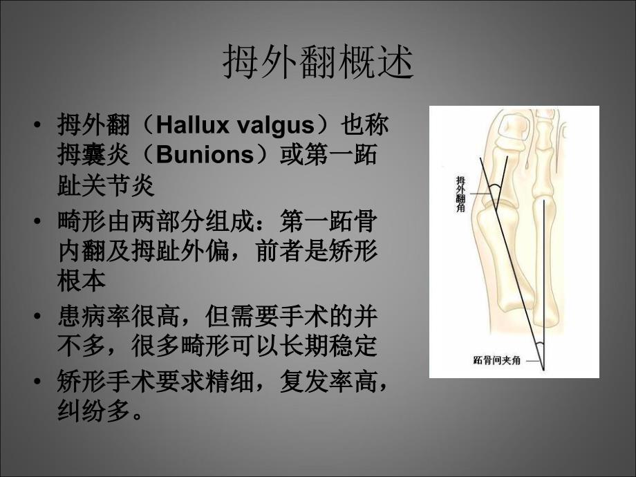 拇外翻手术进展课件.ppt_第3页