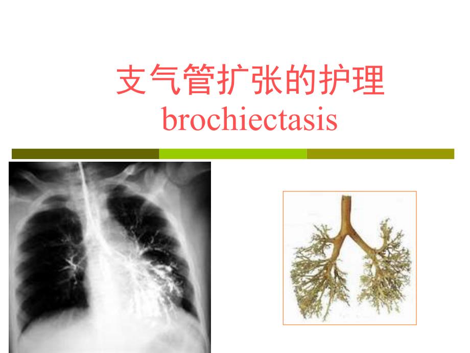 支气管扩张的护理ppt课件.ppt_第1页