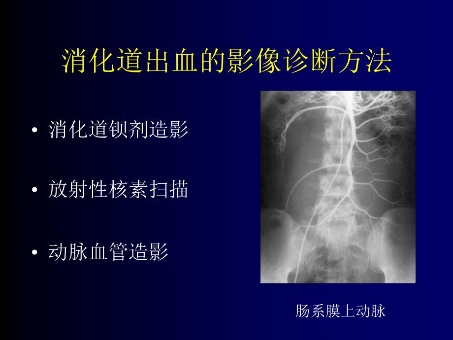 消化道出血介入治疗.ppt_第3页