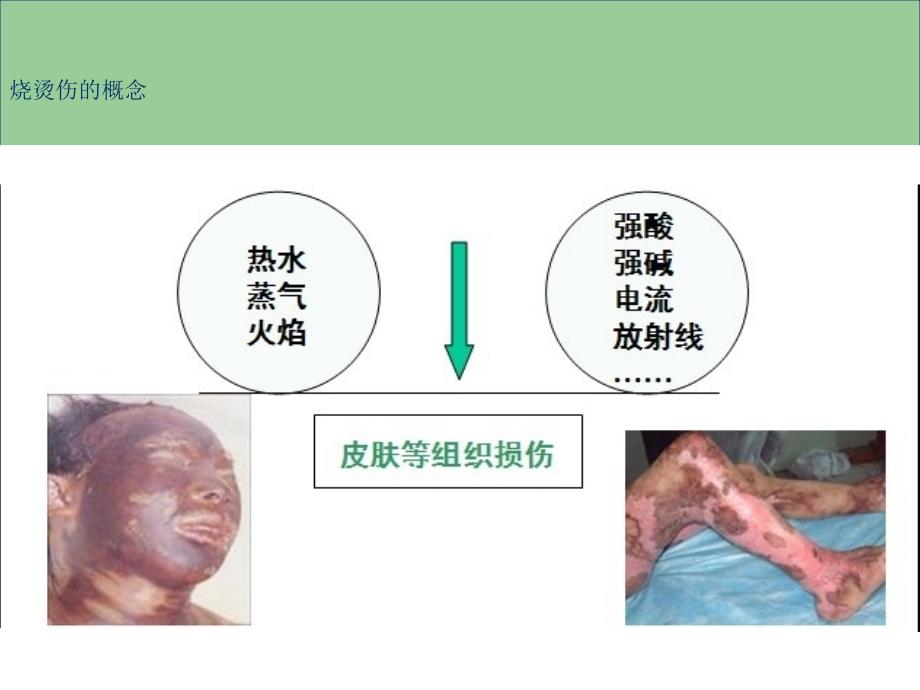烧烫伤的现场急救PPT课件.ppt_第2页
