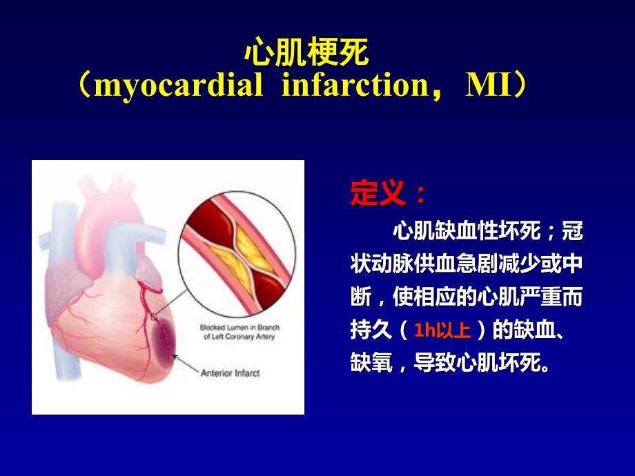 心肌梗死课件.ppt_第3页