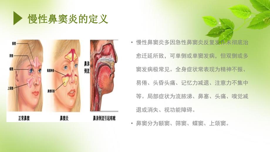 慢性鼻窦炎护理查房.pptx_第2页