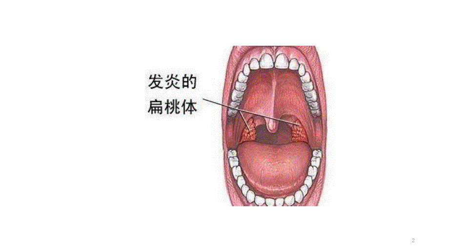 扁桃体切除术后护理PPT课件.ppt_第2页