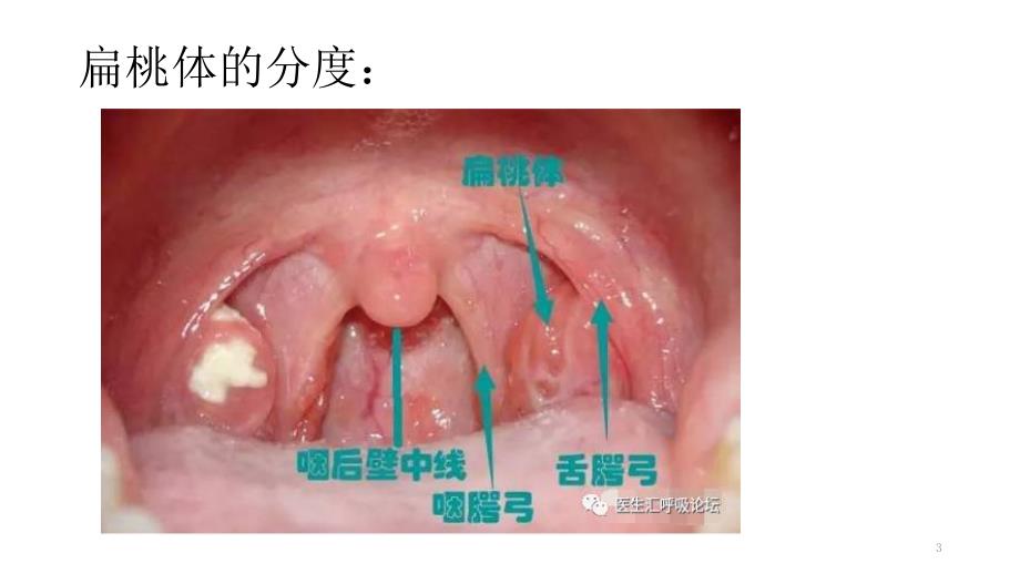 扁桃体切除术后护理PPT课件.ppt_第3页