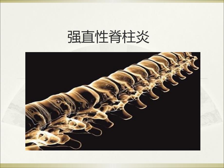 强直性脊柱炎PPT课件.ppt_第2页