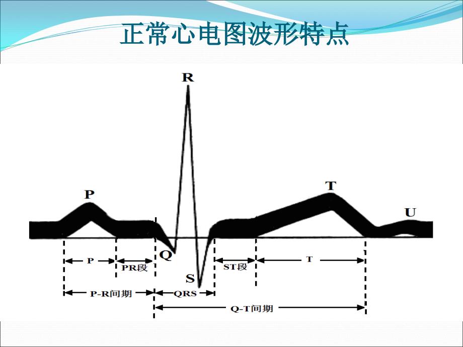 常见异常心电图的识别及处理.ppt_第3页