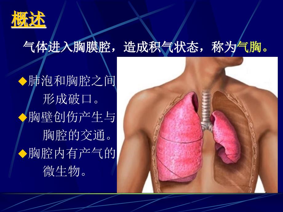 气胸PPT课件.ppt_第2页