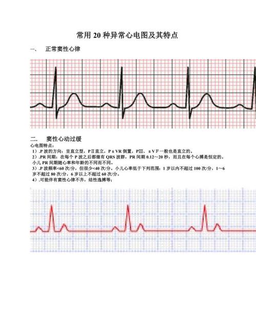 常用20种异常心电图及其特点.doc