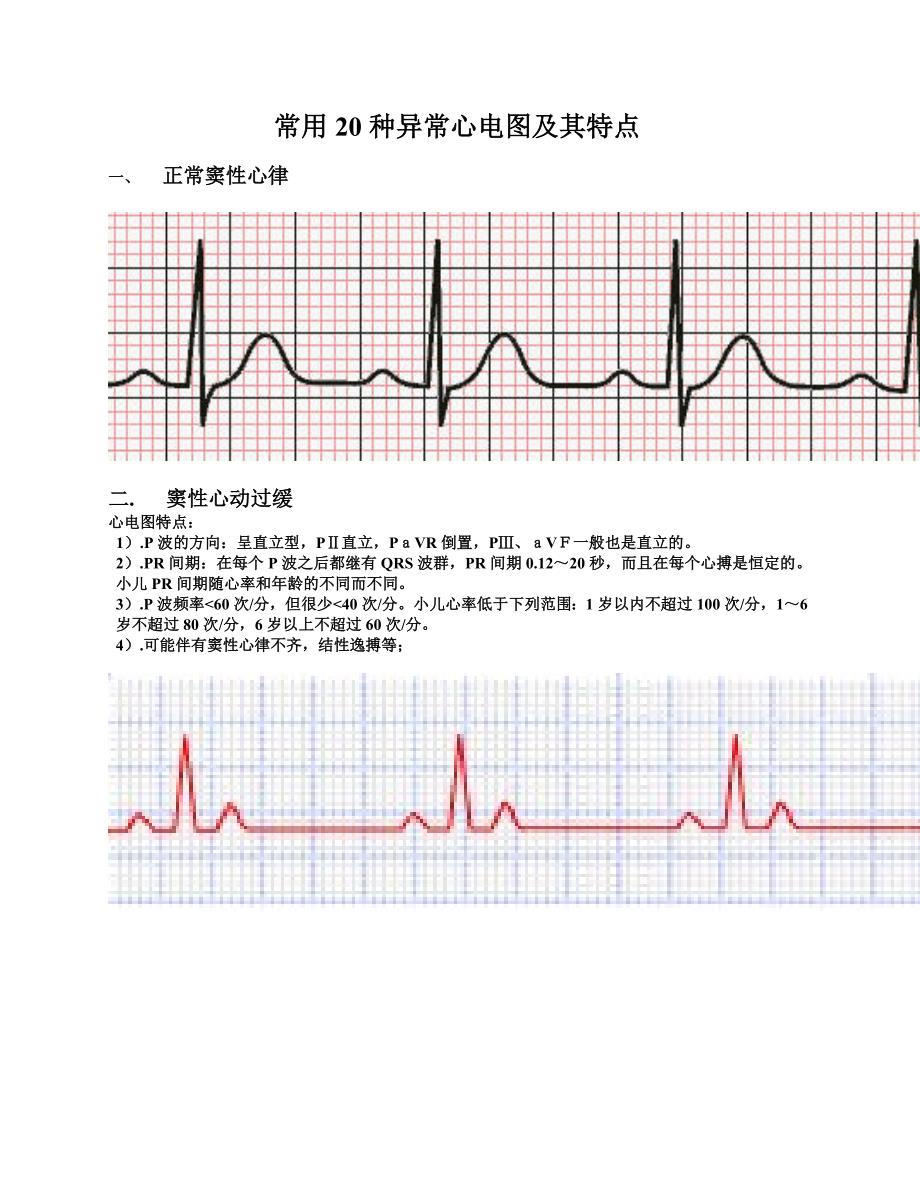 常用20种异常心电图及其特点.doc_第1页