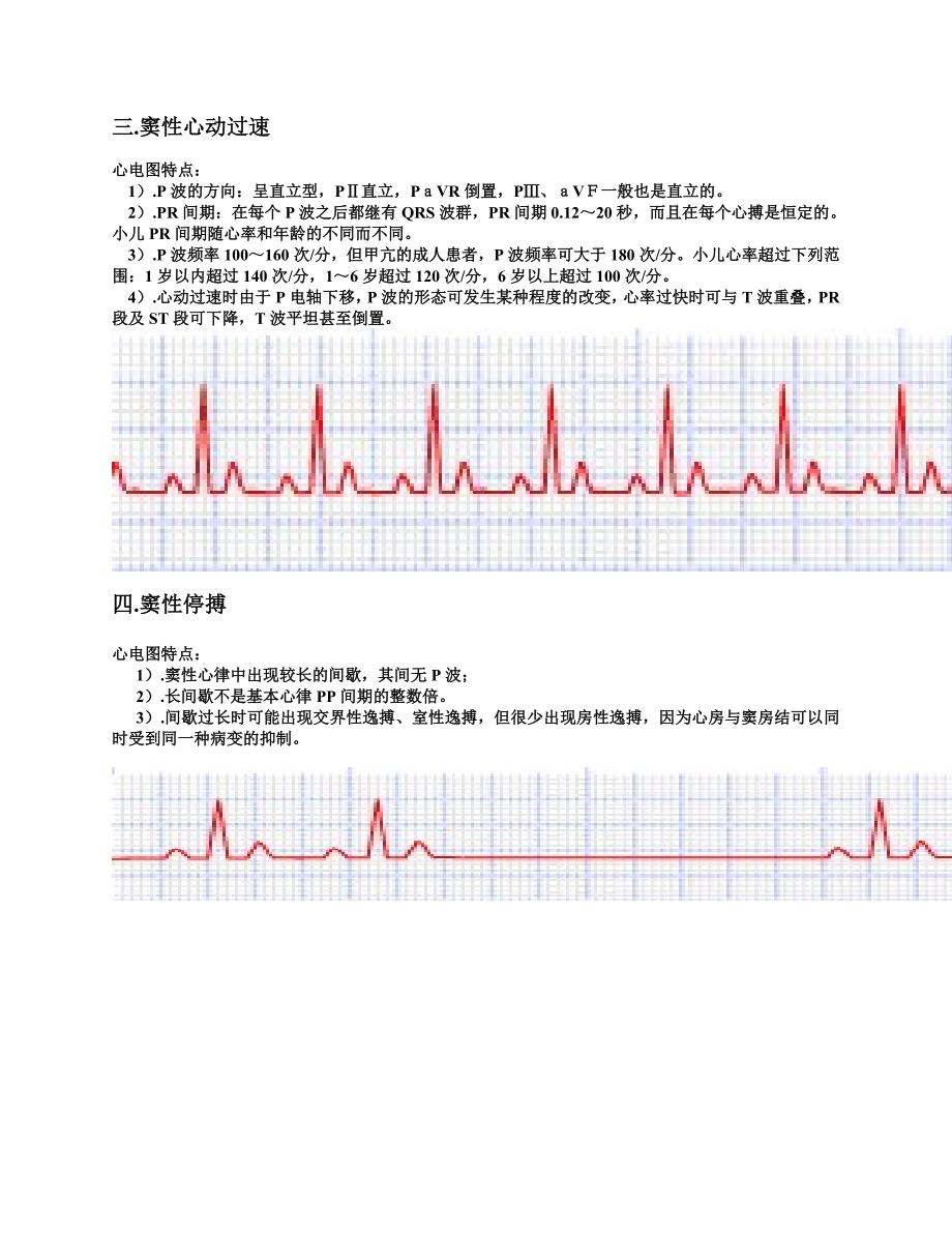 常用20种异常心电图及其特点.doc_第2页