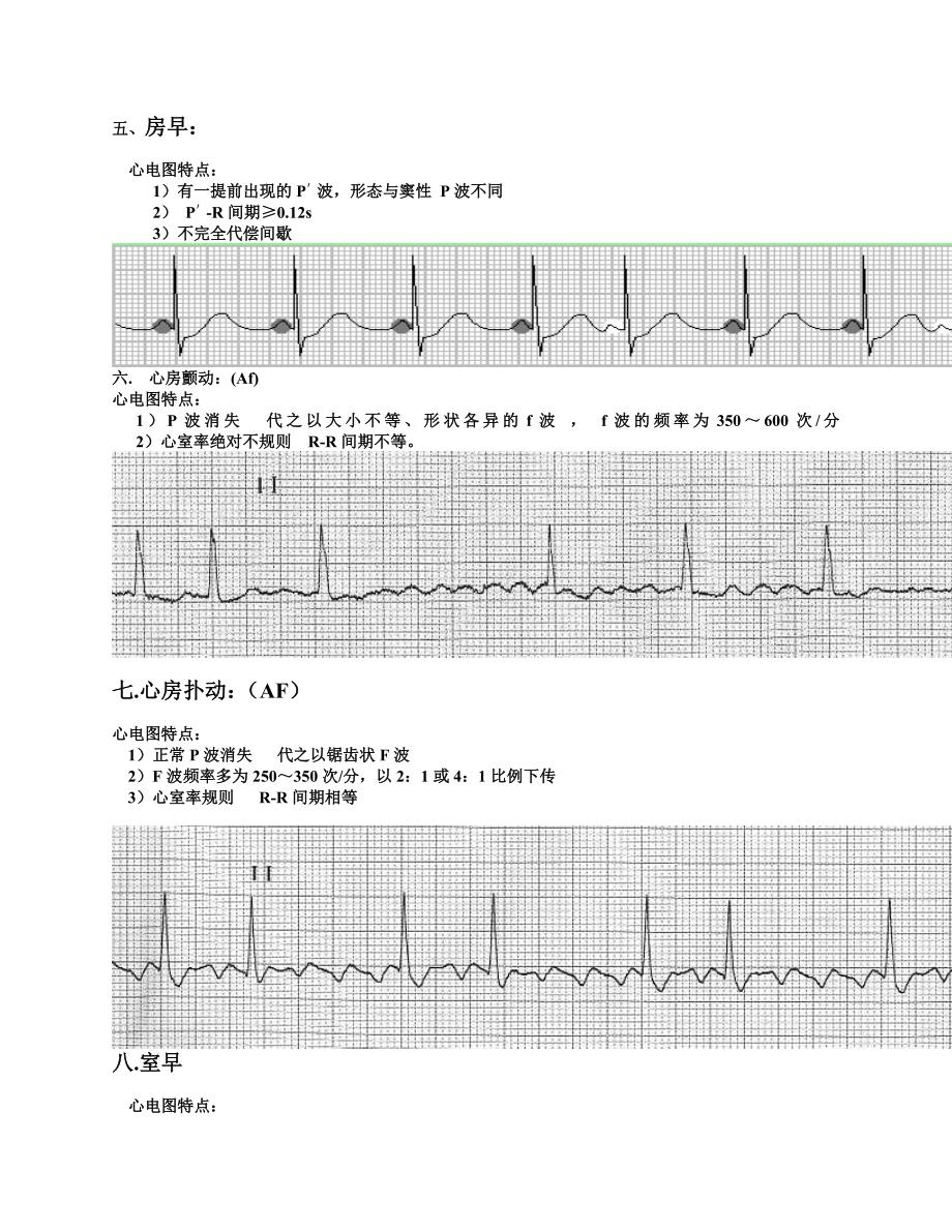 常用20种异常心电图及其特点.doc_第3页