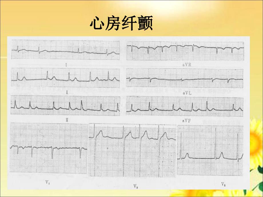 心房纤颤的治疗PPT课件.ppt_第2页