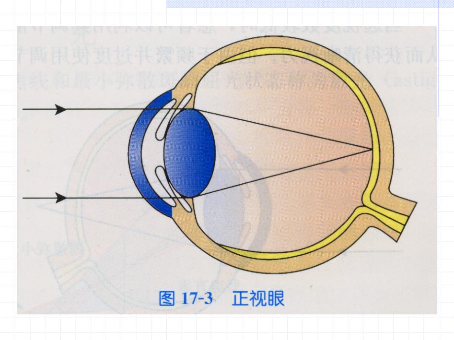 屈光不正护理PPT课件.ppt_第3页