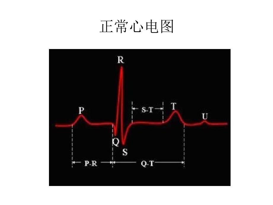 心电图危急值ppt课件.pptx_第3页