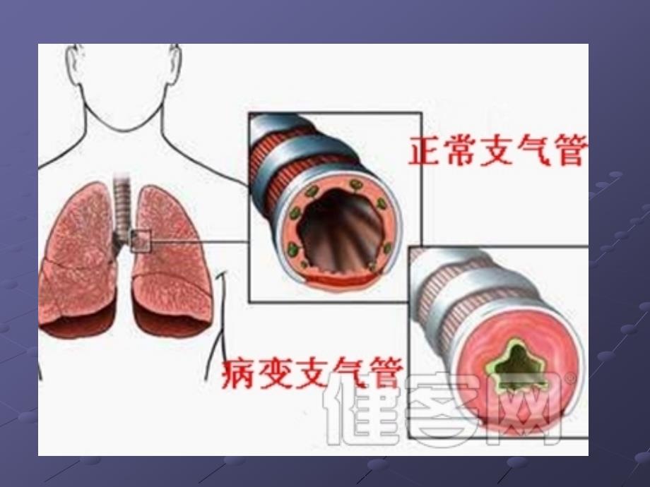 支气管扩张症护理查房.ppt_第3页