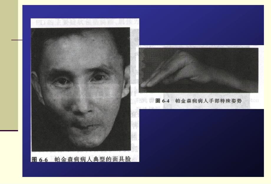 帕金森病护理常规.ppt_第2页