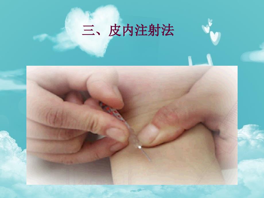 皮内注射PPT课件.ppt_第2页