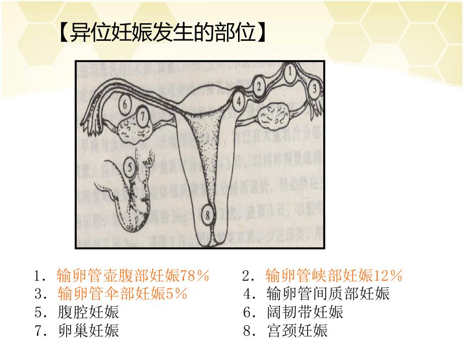 异位妊娠的护理PPT课件.ppt_第3页
