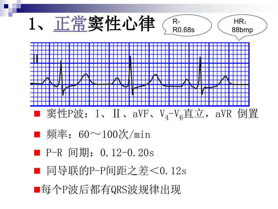 心律失常实验课用.ppt_第3页
