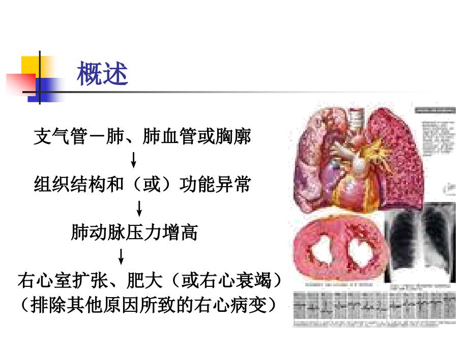慢性肺源性心脏病PPT课件.ppt_第3页