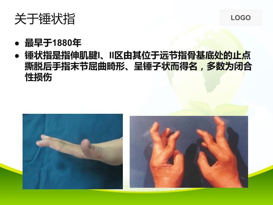 支具在锤状指康复中的应用.ppt_第2页