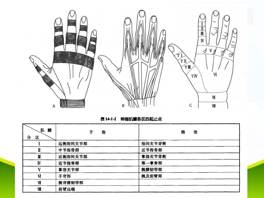 支具在锤状指康复中的应用.ppt_第3页