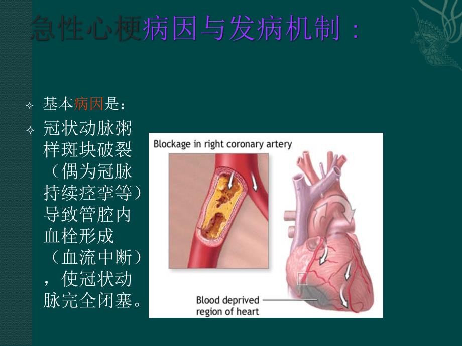 急性心梗溶栓的护理.ppt_第3页