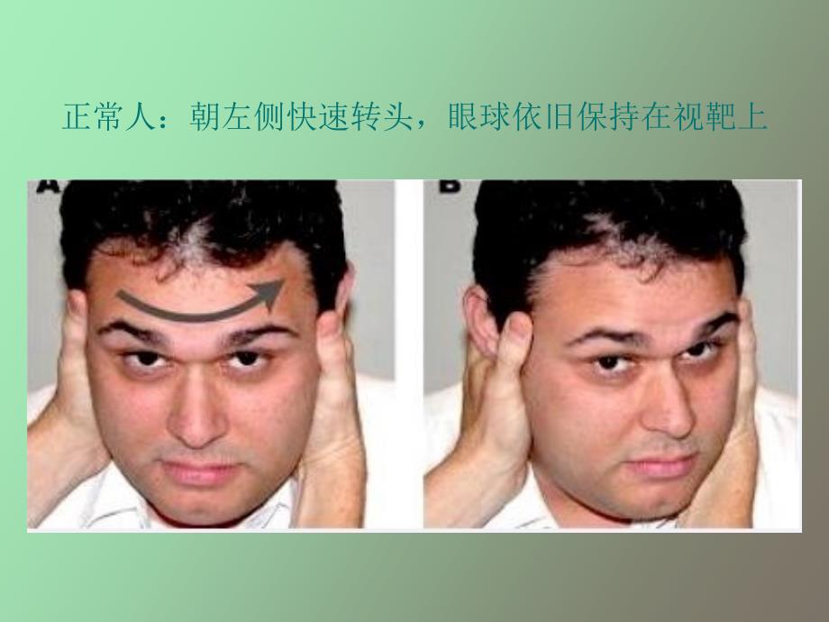 床旁前庭检查甩头试验.ppt_第3页
