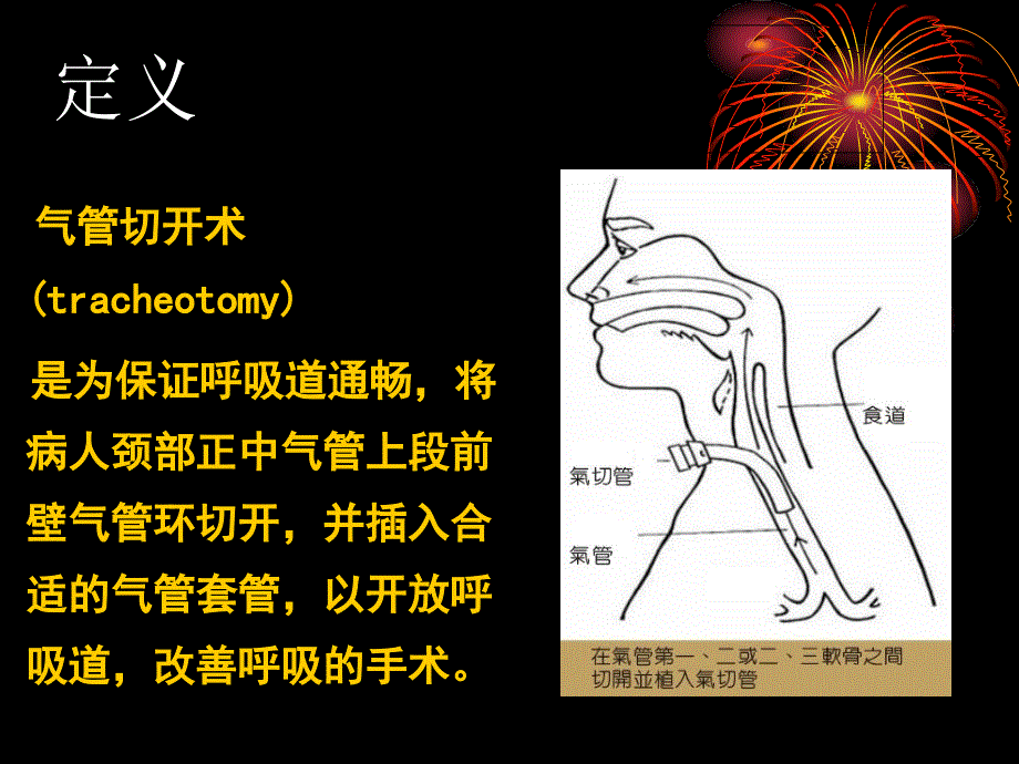 气管切开的护理PPT课件.ppt_第3页