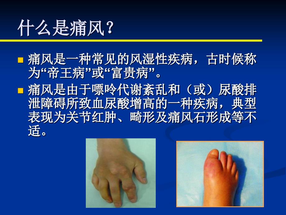 痛风健康科普讲座PPT课件.ppt_第2页