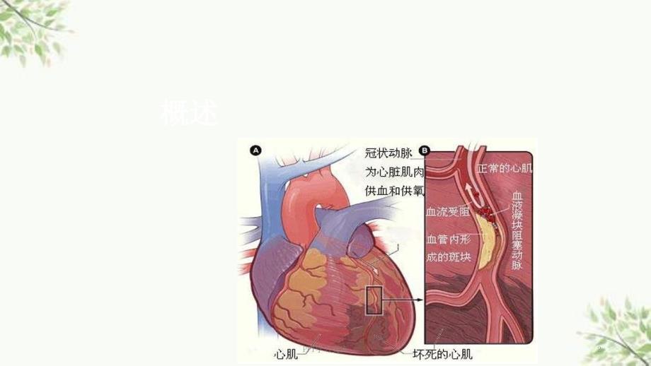 急性心肌梗死的临床生化指标及检测方法ppt课件.ppt_第2页