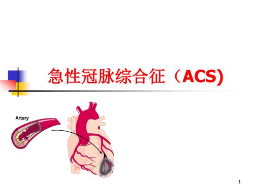 急性冠脉综合征.ppt
