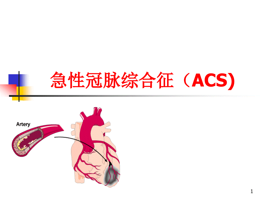 急性冠脉综合征.ppt_第1页
