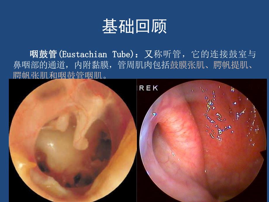 浅谈咽鼓管功能障碍的诊治.ppt_第2页