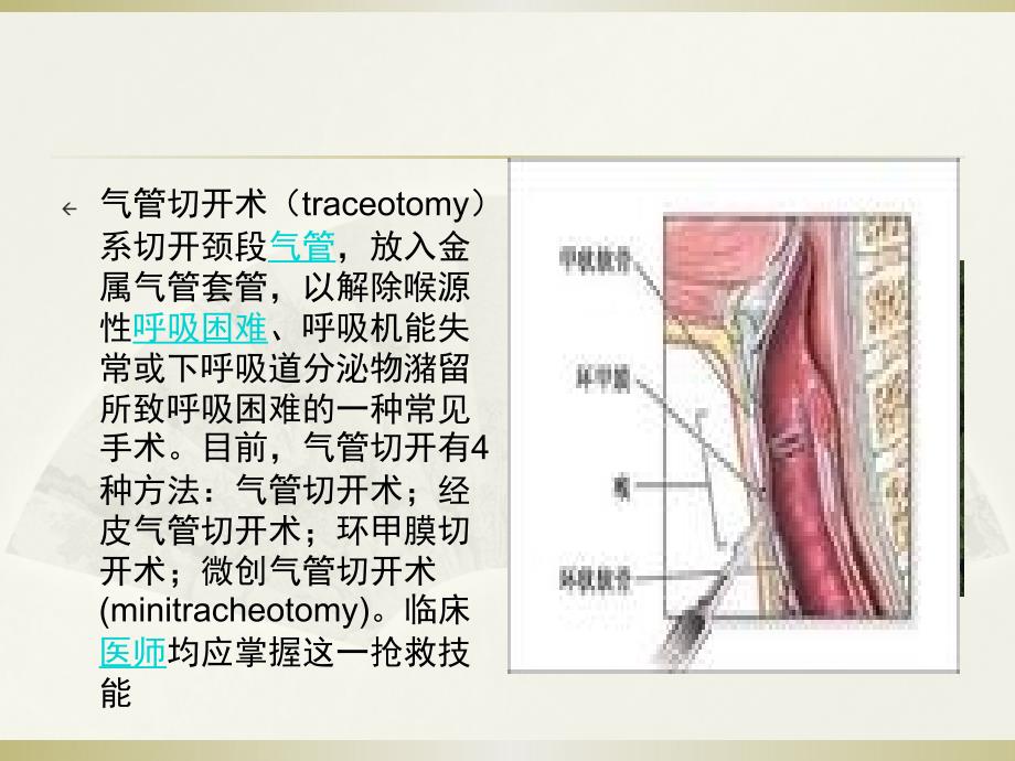 气管切开护理ppt课件.pptx_第2页