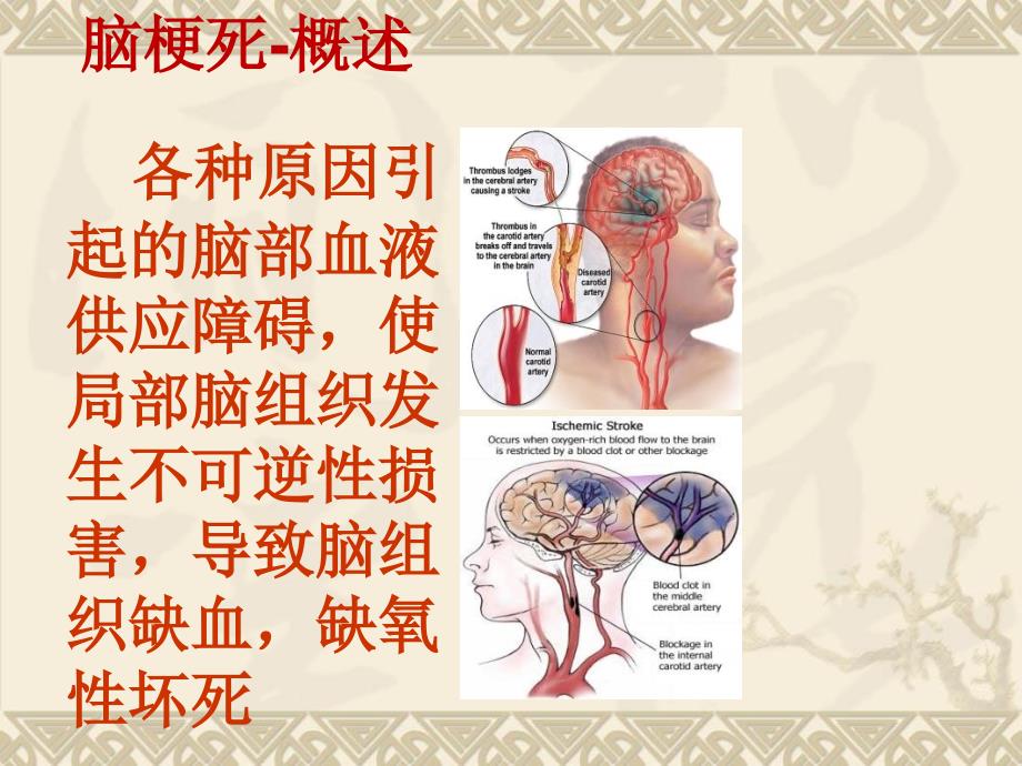 最经典的脑梗死临床表现及治疗.ppt_第2页