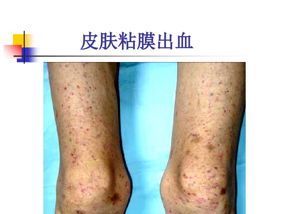 皮肤黏膜出血PPT课件.ppt_第3页