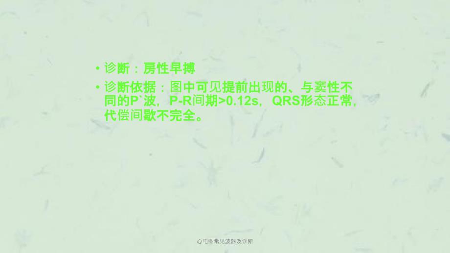 心电图常见波形及诊断课件.ppt_第3页