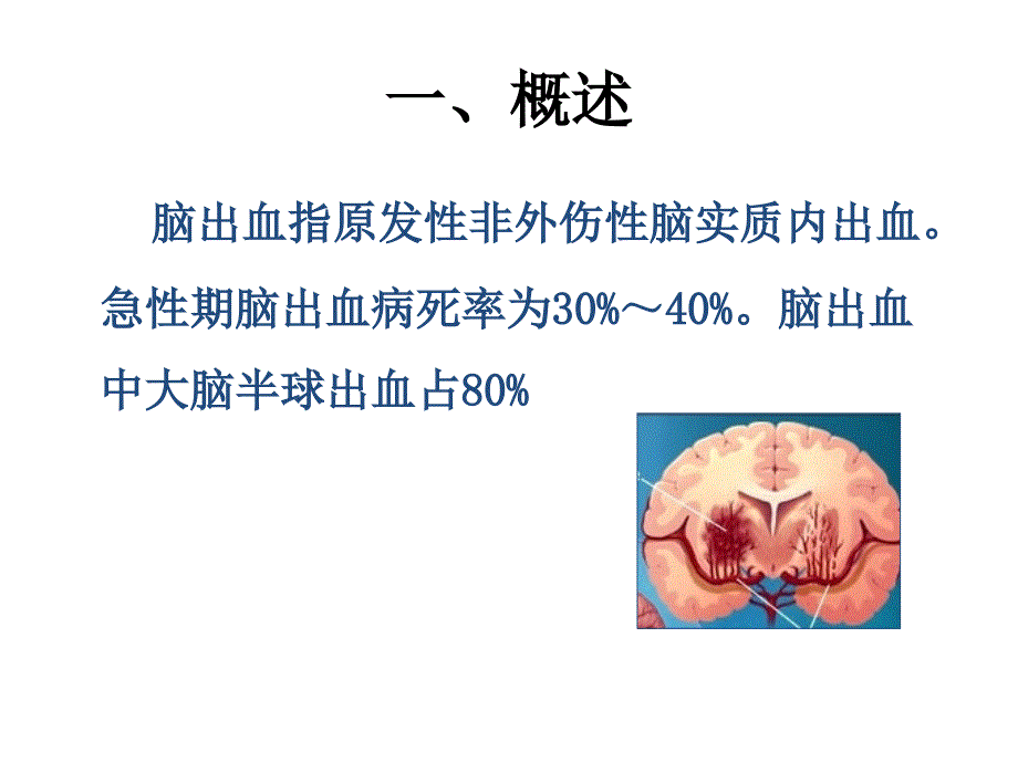 脑出血护理PPT课件.ppt_第2页