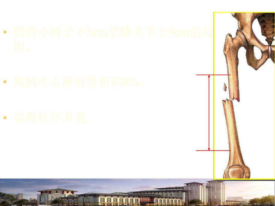 股骨干骨折骨折PPT课件.ppt_第2页
