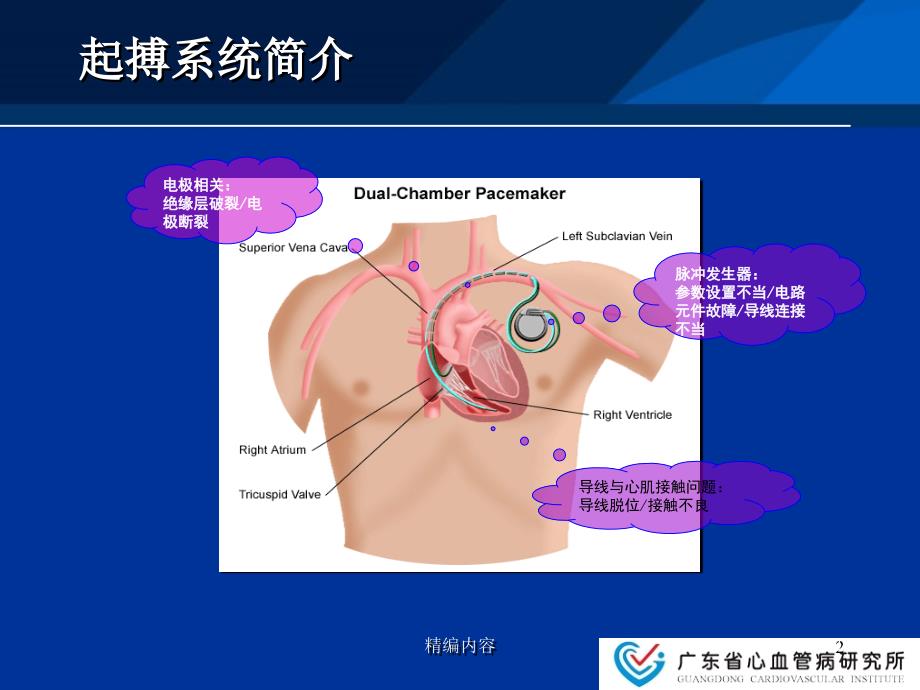 起搏器故障心电图分析深度分析.ppt_第2页