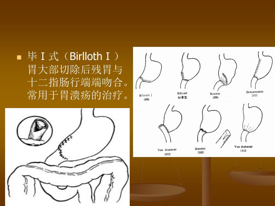 胃大部切除术后并发症及其防治.ppt_第3页