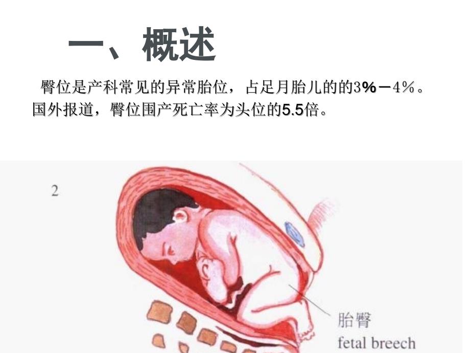 臀位分娩.ppt_第2页