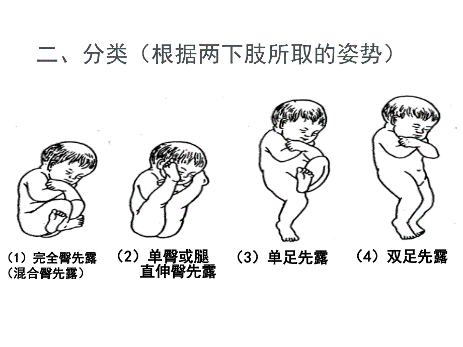 臀位分娩.ppt_第3页