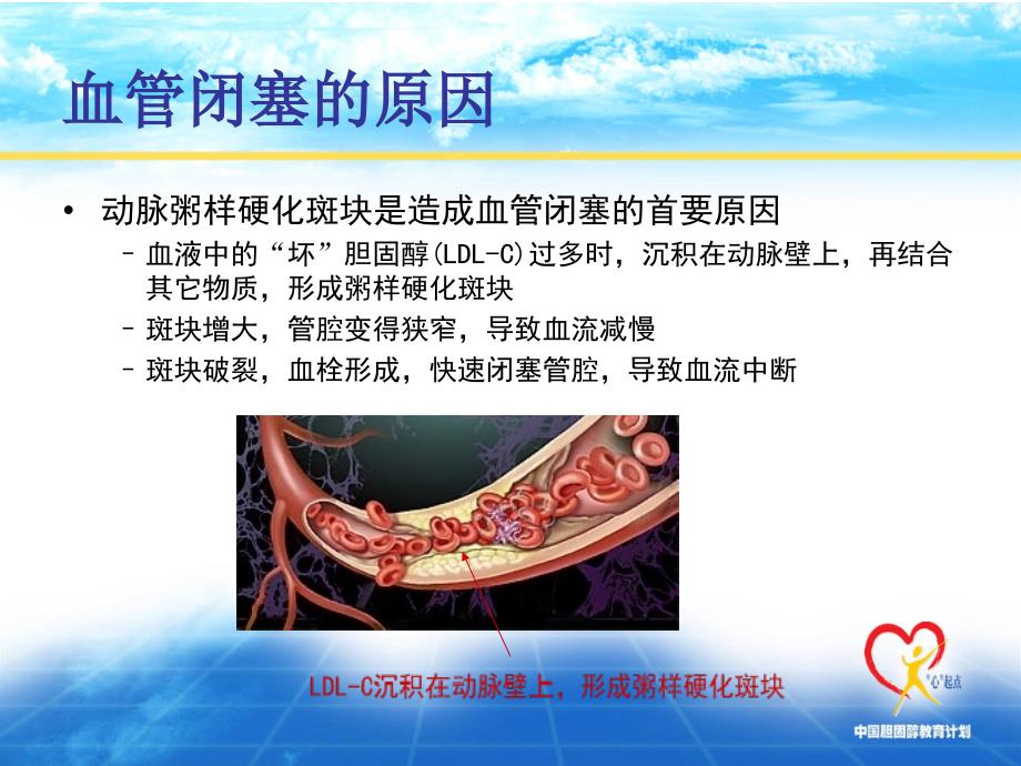 预防心梗发生PPT课件.ppt_第3页