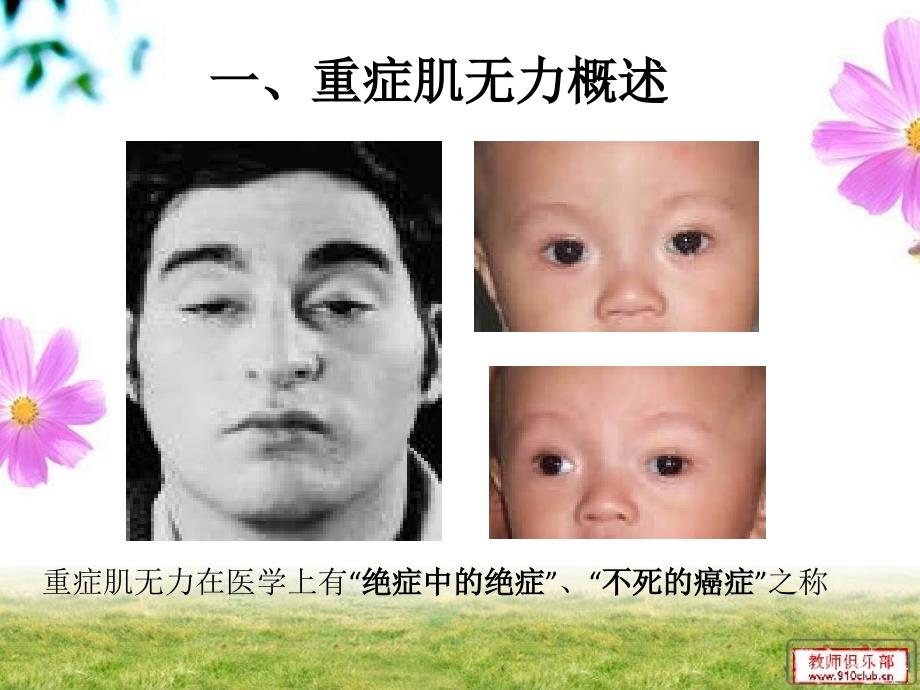 重症肌无力综述PPT课件.ppt_第3页