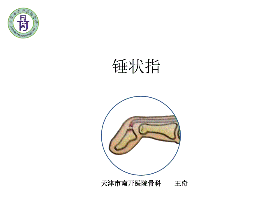 锤状指ppt课件.pptx_第1页