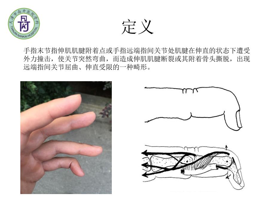 锤状指ppt课件.pptx_第2页