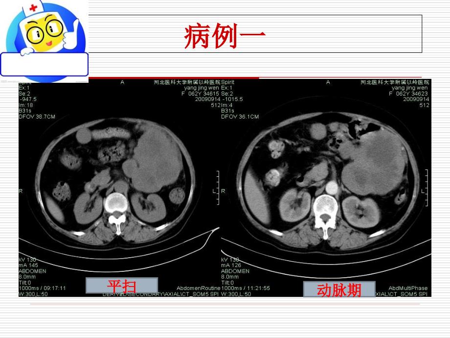 胃肠道间质瘤的影像诊断课件.ppt_第3页